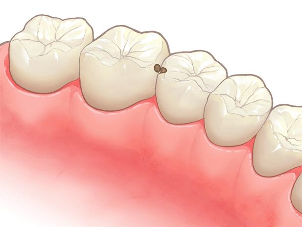 むし歯1