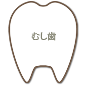むし歯