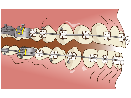 ブラケット矯正