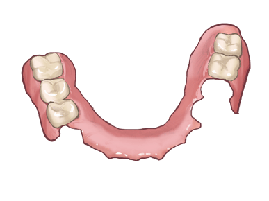 ノンクラスプデンチャー