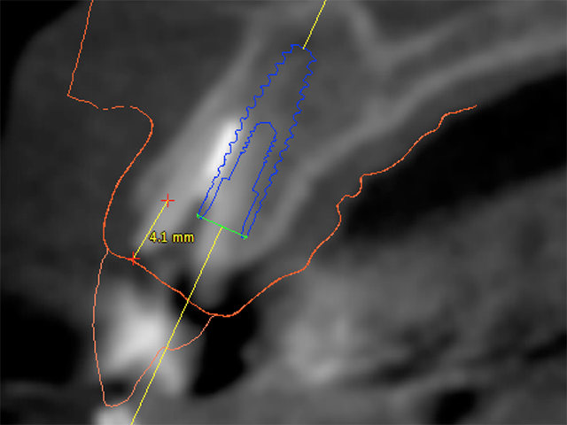 口腔内スキャナーとCTのドッキング