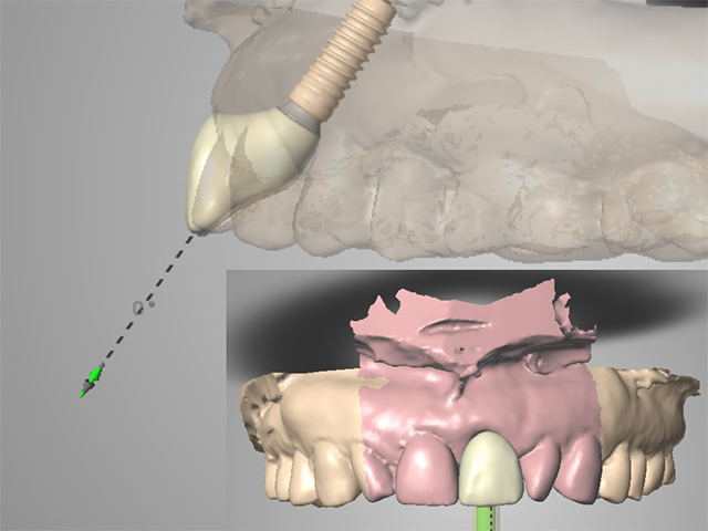 インプラントについてはCADCAMで治療用装置を作成