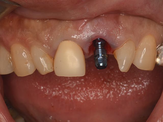 インプラント2