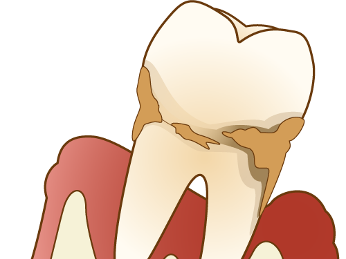 歯周病ってどんな病気